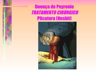 Doença de Peyronie TRATAMENTO CIRÚRGICO Plicatura (Nesbit) 