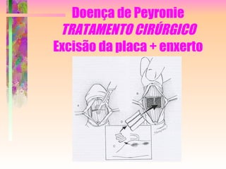 Doença de Peyronie TRATAMENTO CIRÚRGICO Excisão da placa + enxerto 