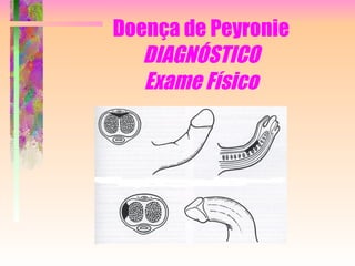 Doença de Peyronie DIAGNÓSTICO Exame Físico 
