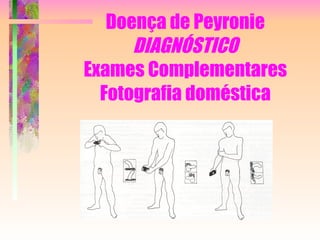 Doença de Peyronie DIAGNÓSTICO Exames Complementares Fotografia doméstica 