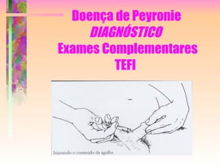 Doença de Peyronie DIAGNÓSTICO    Exames Complementares TEFI  