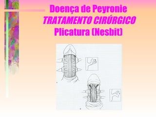 Doença de Peyronie TRATAMENTO CIRÚRGICO Plicatura (Nesbit) 