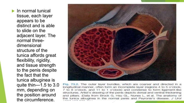 Peyronies disease.pptx
