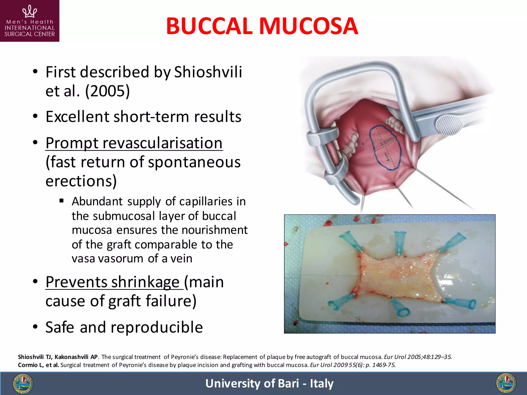 Peyronie's Disease: a tailored surgical procedure for every patient | PDF