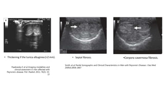 Peyronies disease: diagnostic | PPTX