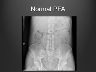 Pfa Matrix Approach to PFA Interpretation | PPTX