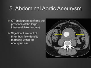 Approach to PFA Interpretation | PPTX