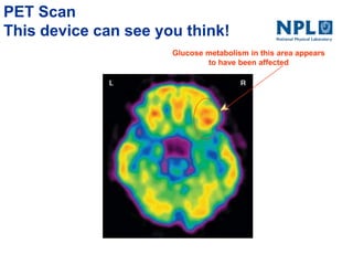 PET Scan
This device can see you think!
Glucose metabolism in this area appears
to have been affected
 