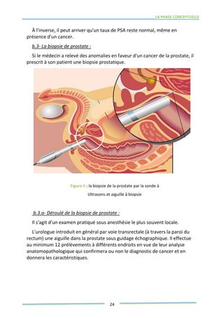 LA PHASE CONCEPTUELLE
24
À l'inverse, il peut arriver qu'un taux de PSA reste normal, même en
présence d'un cancer.
b.3- La biopsie de prostate :
Si le médecin a relevé des anomalies en faveur d'un cancer de la prostate, il
prescrit à son patient une biopsie prostatique.
Figure 8 : la biopsie de la prostate par la sonde à
Ultrasons et aiguille à biopsie
b.3.a- Déroulé de la biopsie de prostate :
Il s'agit d'un examen pratiqué sous anesthésie le plus souvent locale.
L'urologue introduit en général par voie transrectale (à travers la paroi du
rectum) une aiguille dans la prostate sous guidage échographique. Il effectue
au minimum 12 prélèvements à différents endroits en vue de leur analyse
anatomopathologique qui confirmera ou non le diagnostic de cancer et en
donnera les caractéristiques.
 