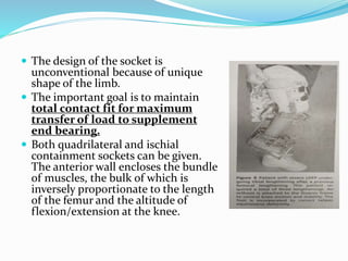 PFFD [proximal femoral focal deficiency] | PPTX