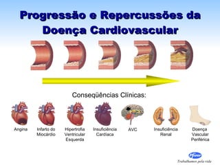 Progressão e Repercussões da Doença Cardiovascular Angina Infarto do  Miocárdio  Hipertrofia Ventricular Esquerda Insuficiência Cardíaca Conseqüências Clínicas: AVC Insuficiência Renal Doença  Vascular Periférica 