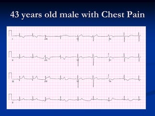 43 years old male with Chest Pain