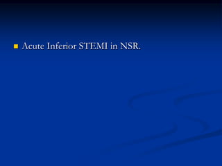 Acute Inferior STEMI in NSR.
