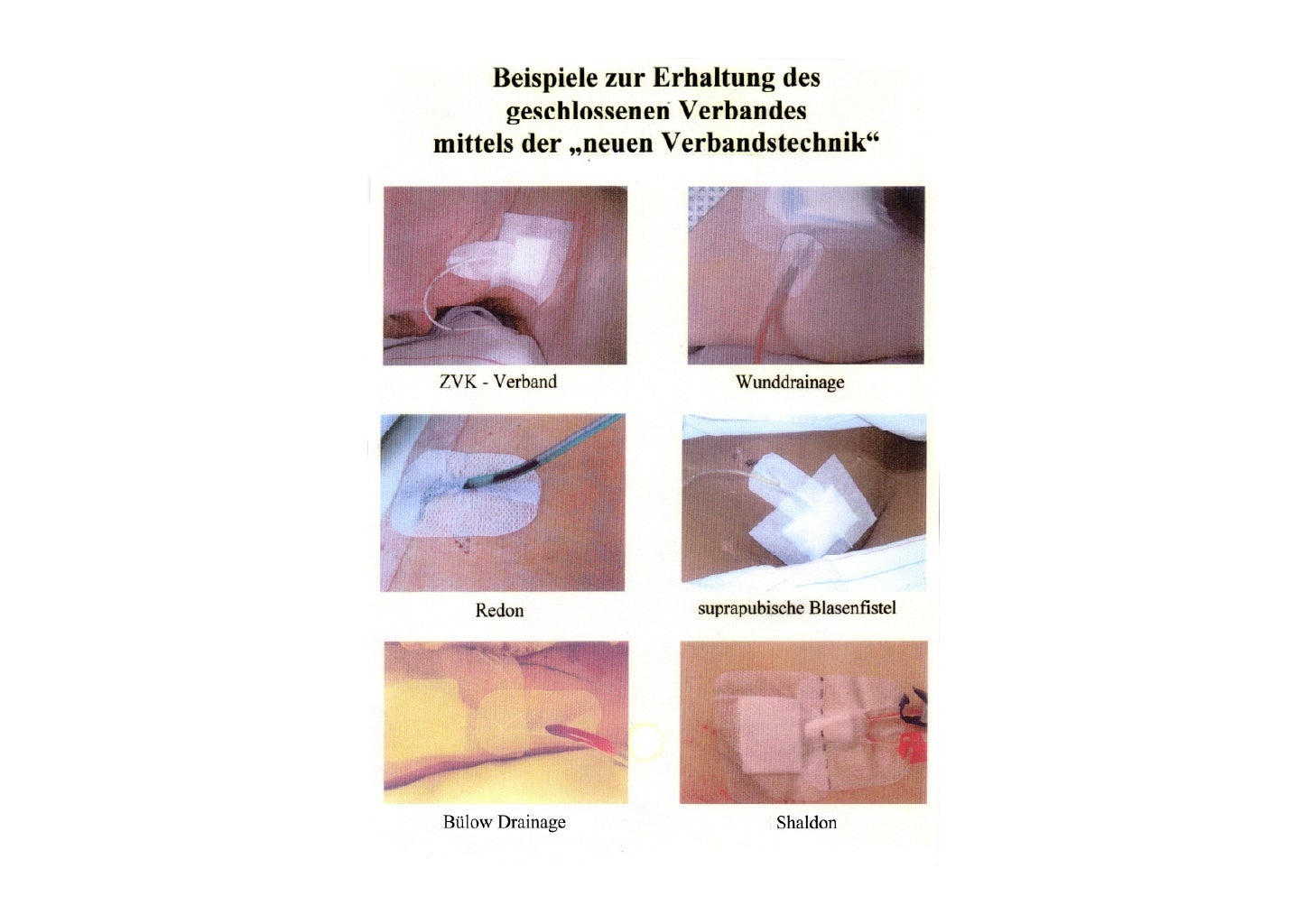 NPK2011 Katheter und Drainagen sicher fixieren Neue Verbandtechnik