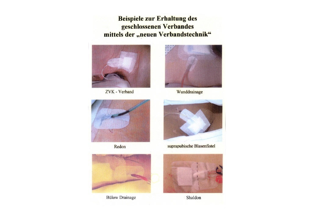 NPK2011 Katheter und Drainagen sicher fixieren Neue Verbandtechnik