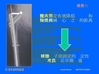 Justin Rowe  MATHYS CHINA 髓内固定有效降低髋关节和 股骨机械轴心线之间的距离 增加转子部固定的稳定性 可以术后早期负重 特点与优势 