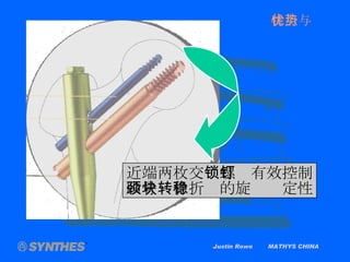 Justin Rowe  MATHYS CHINA 近端两枚交 锁螺钉有效控制 股骨颈骨折块的旋转稳定性 特点与优势 