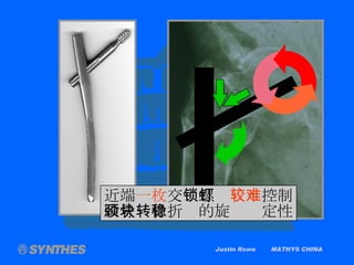 Justin Rowe  MATHYS CHINA 近端 一枚 交 锁螺钉 较难 控制 股骨颈骨折块的旋转稳定性 