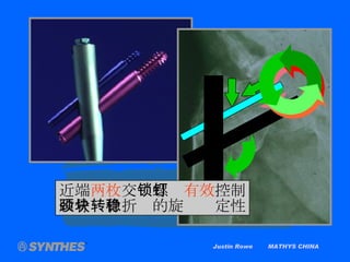 Justin Rowe  MATHYS CHINA 近端 两枚 交 锁螺钉 有效 控制 股骨颈骨折块的旋转稳定性 