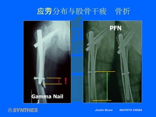 Gamma Nail PFN Justin Rowe  MATHYS CHINA 应力分布与股骨干疲劳骨折 ! 