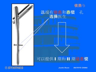 Justin Rowe  MATHYS CHINA 远端有 动态 和 静态 交锁孔 可供医生选择 可以提供 I 期和 II 期 动态 交锁 特点与优势 