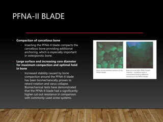 PFNA-II BLADE
• Compaction of cancellous bone
• Inserting the PFNA-II blade compacts the
cancellous bone providing additional
anchoring, which is especially important
in osteoporotic bone.
• Large surface and increasing core diameter
for maximum compaction and optimal hold
in bone
• Increased stability caused by bone
compaction around the PFNA-II blade
has been biomechanically proven to
retard rotation and varus collapse.
Biomechanical tests have demonstrated
that the PFNA-II blade had a significantly
higher cut-out resistance in comparison
with commonly-used screw systems.
 