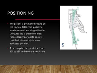 POSITIONING
• The patient is positioned supine on
the fracture table. The ipsilateral
arm is elevated in a sling while the
uninjured leg is placed on a leg
holder. It is important to ensure
that the ipsilateral hip is in an
adducted position.
• To accomplish this, push the torso
10º to 15º to the contralateral side
 