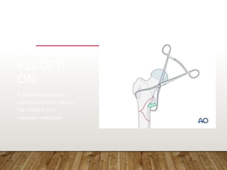 OPEN
REDUCTI
ON
A pointed reduction
clamp is used to reduce
the fracture and
maintain reduction.
 