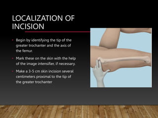 LOCALIZATION OF
INCISION
• Begin by identifying the tip of the
greater trochanter and the axis of
the femur.
• Mark these on the skin with the help
of the image intensifier, if necessary.
• Make a 3-5 cm skin incision several
centimeters proximal to the tip of
the greater trochanter
 