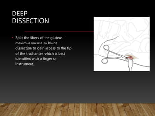 DEEP
DISSECTION
• Split the fibers of the gluteus
maximus muscle by blunt
dissection to gain access to the tip
of the trochanter, which is best
identified with a finger or
instrument.
 
