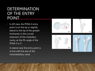 DETERMINATION
OF THE ENTRY
POINT
• In AP view, the PFNA-II entry
point is on the tip or slightly
lateral to the tip of the greater
trochanter in the curved
extension of the medullary
cavity, as the ML angle of the
PFNA-II is 5°.
• In lateral view the entry point is
in line with the axis of the
intramedullary canal.
 