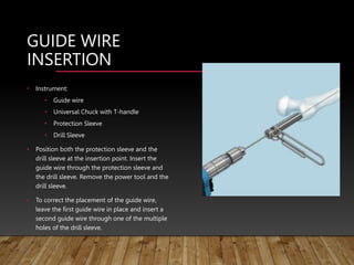 GUIDE WIRE
INSERTION
• Instrument:
• Guide wire
• Universal Chuck with T-handle
• Protection Sleeve
• Drill Sleeve
• Position both the protection sleeve and the
drill sleeve at the insertion point. Insert the
guide wire through the protection sleeve and
the drill sleeve. Remove the power tool and the
drill sleeve.
• To correct the placement of the guide wire,
leave the first guide wire in place and insert a
second guide wire through one of the multiple
holes of the drill sleeve.
 