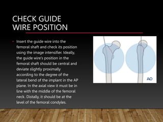 CHECK GUIDE
WIRE POSITION
• Insert the guide wire into the
femoral shaft and check its position
using the image intensifier. Ideally,
the guide wire’s position in the
femoral shaft should be central and
deviate slightly proximally
according to the degree of the
lateral bend of the implant in the AP
plane. In the axial view it must be in
line with the middle of the femoral
neck. Distally, it should be at the
level of the femoral condyles.
 