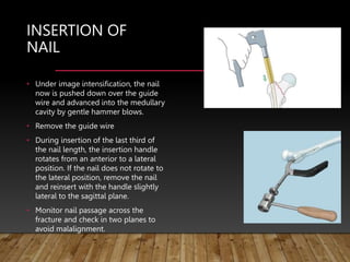 INSERTION OF
NAIL
• Under image intensification, the nail
now is pushed down over the guide
wire and advanced into the medullary
cavity by gentle hammer blows.
• Remove the guide wire
• During insertion of the last third of
the nail length, the insertion handle
rotates from an anterior to a lateral
position. If the nail does not rotate to
the lateral position, remove the nail
and reinsert with the handle slightly
lateral to the sagittal plane.
• Monitor nail passage across the
fracture and check in two planes to
avoid malalignment.
 