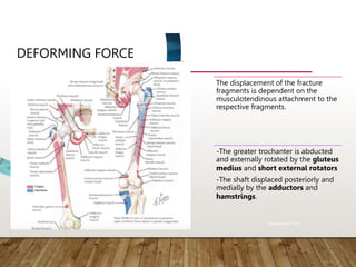 DEFORMING FORCE
The displacement of the fracture
fragments is dependent on the
musculotendinous attachment to the
respective fragments.
-The greater trochanter is abducted
and externally rotated by the gluteus
medius and short external rotators
-The shaft displaced posteriorly and
medially by the adductors and
hamstrings.
Rockwood 8th ed
 