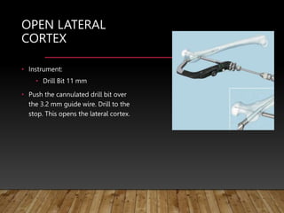 OPEN LATERAL
CORTEX
• Instrument:
• Drill Bit 11 mm
• Push the cannulated drill bit over
the 3.2 mm guide wire. Drill to the
stop. This opens the lateral cortex.
 
