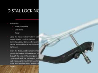 DISTAL LOCKING
• Instrument:
• Protection sleeve
• Drill sleeve
• Trocar
• Using the hexagonal screwdriver with
spherical head, confirm that the
connecting screw between the insertion
handle and the PFNA-II is sufficiently
tightened.
• Insert the three-part trocar combination
(protection sleeve, drill sleeve and trocar)
through the hole in the aiming arm that
corresponds with the nail length, make a
stab incision and insert the trocar to the
bone. Mark the femur and remove the
trocar.
 