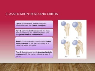 CLASSIFICATION: BOYD AND GRIFFIN
Type 1: Fractures that extend along the
intertrochanteric line (stable –two part)
Type 2: Comminuted fractures with the main
fracture line along the intertrochanteric line
with posteromedial comminution
Type 3: Subtrochanteric extension with lateral
shaft extension of the fracture distally at or
below the lesser trochanter
Type 4: Subtrochanteric with intertrochanteric
extension with the fracture lying in at least 2
planes
Rockwood 8th ed, Campbell
 