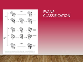 EVANS
CLASSIFICATION
Rockwood 8th ed
 