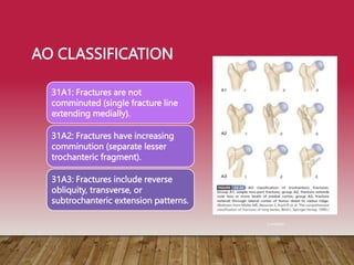 AO CLASSIFICATION
31A1: Fractures are not
comminuted (single fracture line
extending medially).
31A2: Fractures have increasing
comminution (separate lesser
trochanteric fragment).
31A3: Fractures include reverse
obliquity, transverse, or
subtrochanteric extension patterns.
Campbell
 