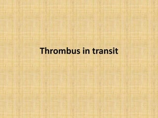 Thrombus in transit
 