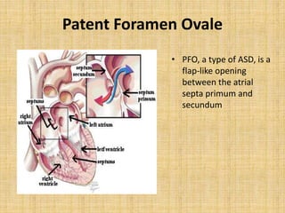 Patent Foramen Ovale
• PFO, a type of ASD, is a
flap-like opening
between the atrial
septa primum and
secundum
 