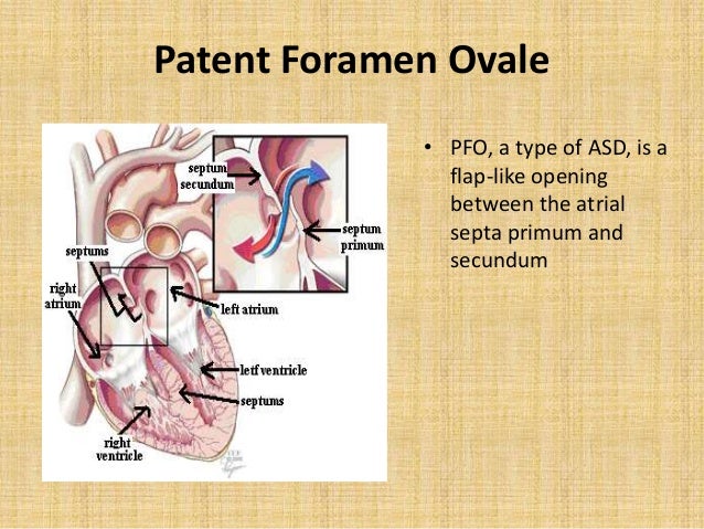 PFO CLOSURE