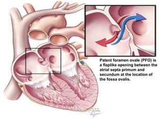 Pfo Pathophysiology Pfo laa closure | PPTX