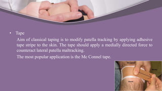 • Tape
Aim of classical taping is to modify patella tracking by applying adhesive
tape stripe to the skin. The tape should apply a medially directed force to
counteract lateral patella maltracking.
The most popular application is the Mc Connel tape.
 