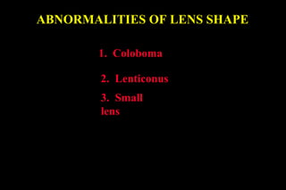 ABNORMALITIES OF LENS SHAPE
2. Lenticonus
1. Coloboma
3. Small
lens
 