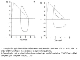 c) Example of a typical restrictive defect (FEV1 66%; FEV1/VC 80%; PEF 79%; TLC 62%). The TLC 
is low and flow is higher than expected at a given lung volume. 
d) Example of a typical mixed defect characterised by a low TLC and a low FEV1/VC ratio (FEV1 
64%; FEV1/VC 64%; PEF 82%; TLC 72%) 
 