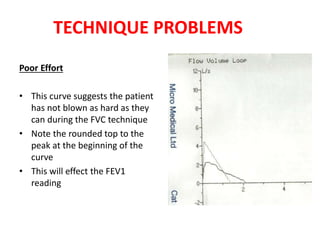 TECHNIQUE PROBLEMS 
Poor Effort 
• This curve suggests the patient 
has not blown as hard as they 
can during the FVC technique 
• Note the rounded top to the 
peak at the beginning of the 
curve 
• This will effect the FEV1 
reading 
 