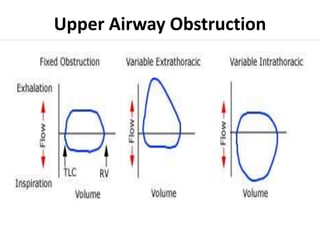 Upper Airway Obstruction 
 