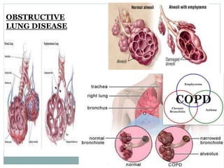 OBSTRUCTIVE
LUNG DISEASE
 